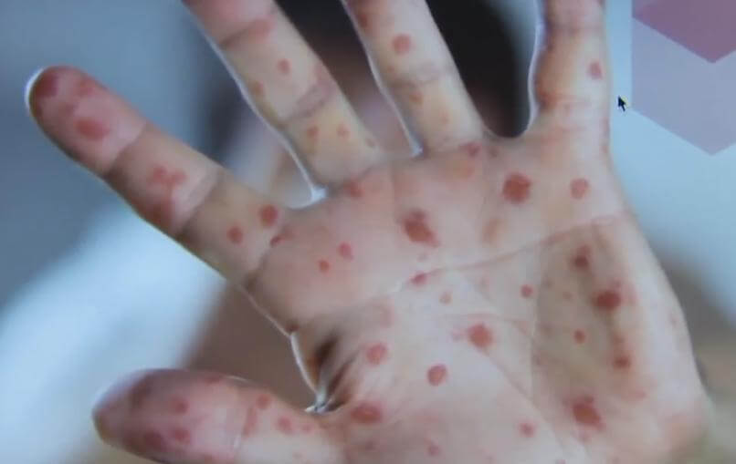 Épidémie de Rougeole à Toulouse (1) Épidémie de Rougeole à Toulouse